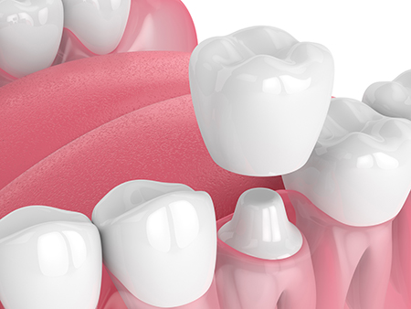 Regency Family Dental | Root Canals, Ceramic Crowns and Pediatric Dentistry