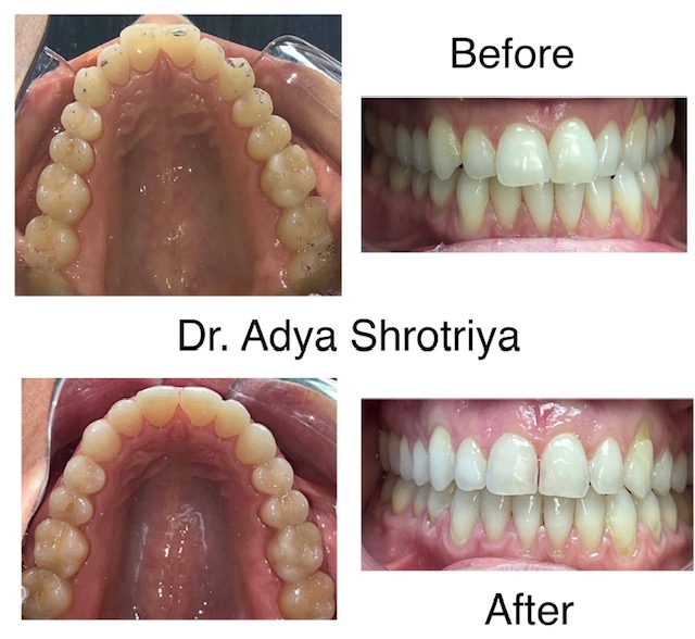 Regency Family Dental | ZOOM! Whitening, Dental Fillings and Invisalign®