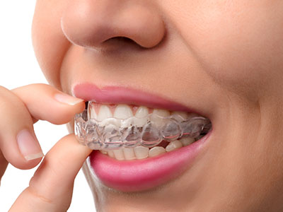 An individual with a toothy smile, wearing clear braces, appears to be examining or adjusting them with their fingers.