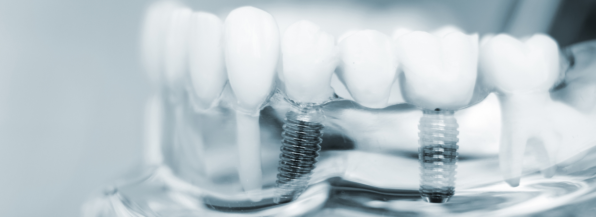 The image shows a close-up view of several teeth with braces, set against a blurred background.